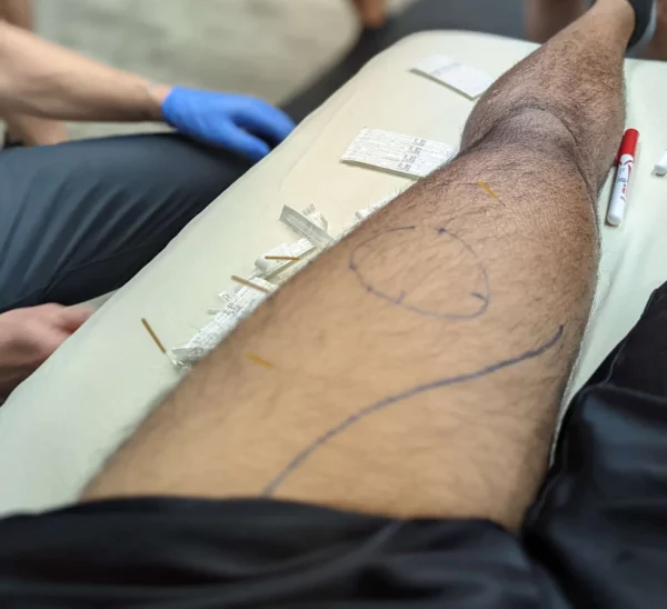 athletic dry needling