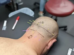 dry-needling-gallery-3